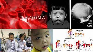 bệnh thalassemia